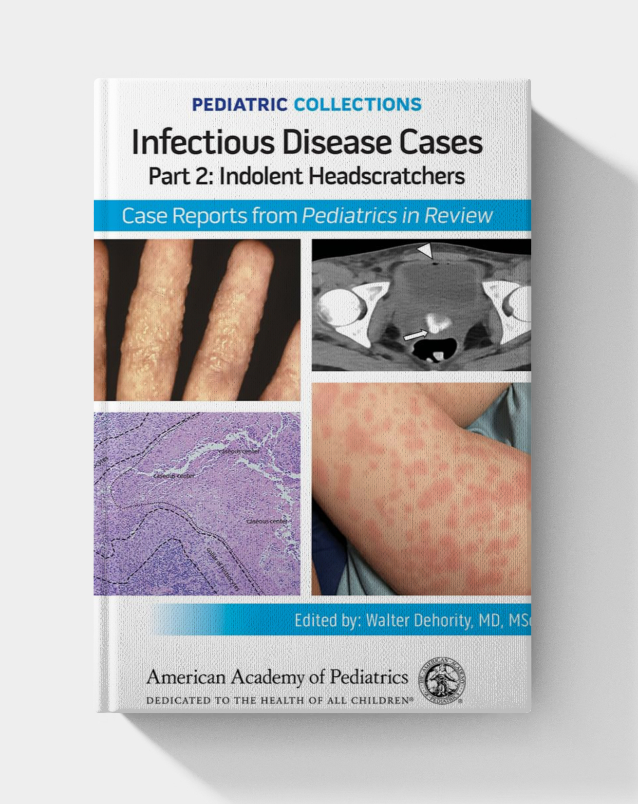 Pediatric Collections: Infectious Disease Cases: Part 2: Indolent Head Scratchers (2025)