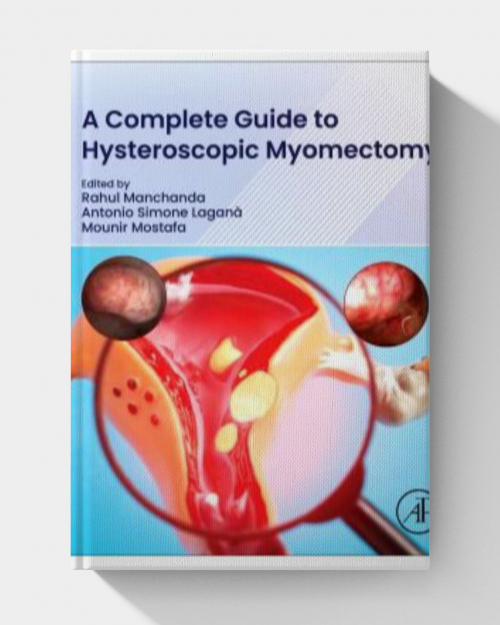 A Complete Guide to Hysteroscopic Myomectomy